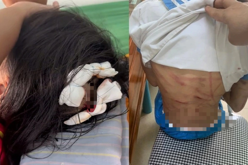 Cha dượng dùng búa đinh, gậy gỗ hành hung bé gái lớp 5 ở Hà Tĩnh